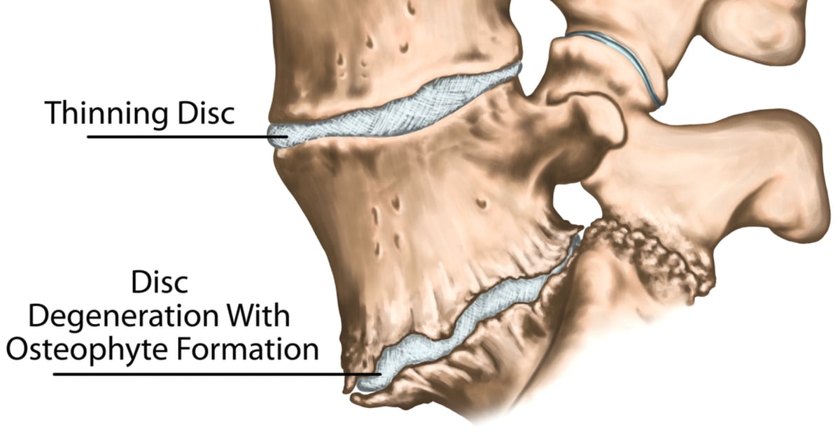 Bone Spurs Of The Spine What Causes Them And How Can They Be Treated 